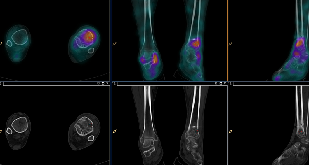 Imagen Molecular por sospecha clínica de osteomielitis
