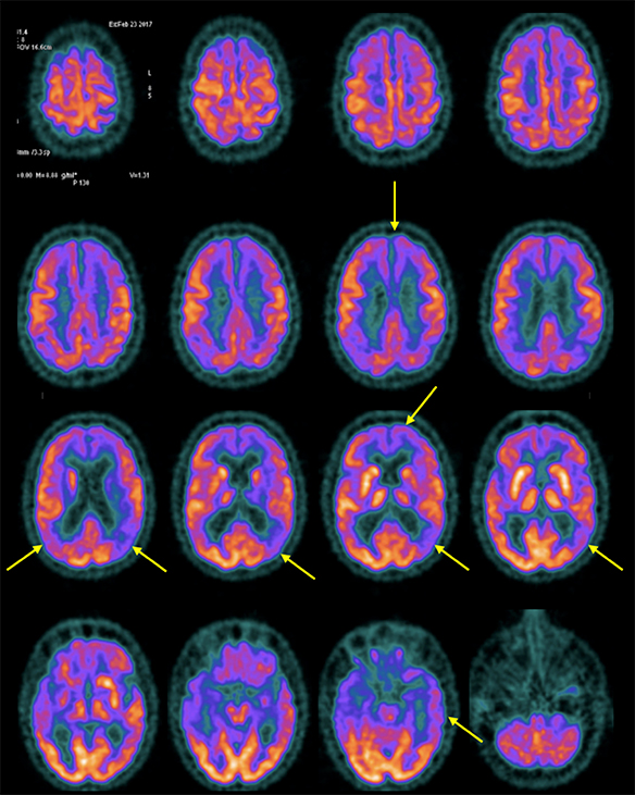 PET CEREBRAL CON FDG ALZHEIMER