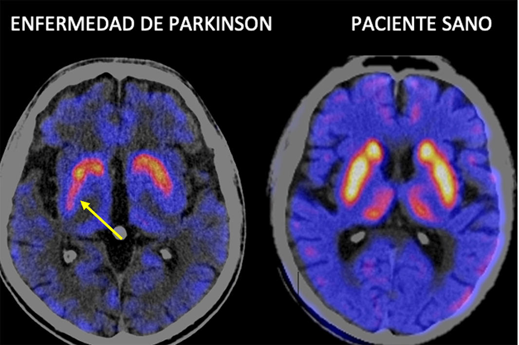 PET CEREBRAL DOPA ENF PARKINSON