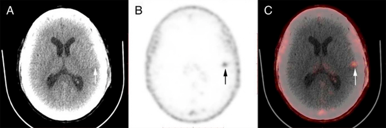 PET CON 18 F FOC METASTASIS CEREBRAL