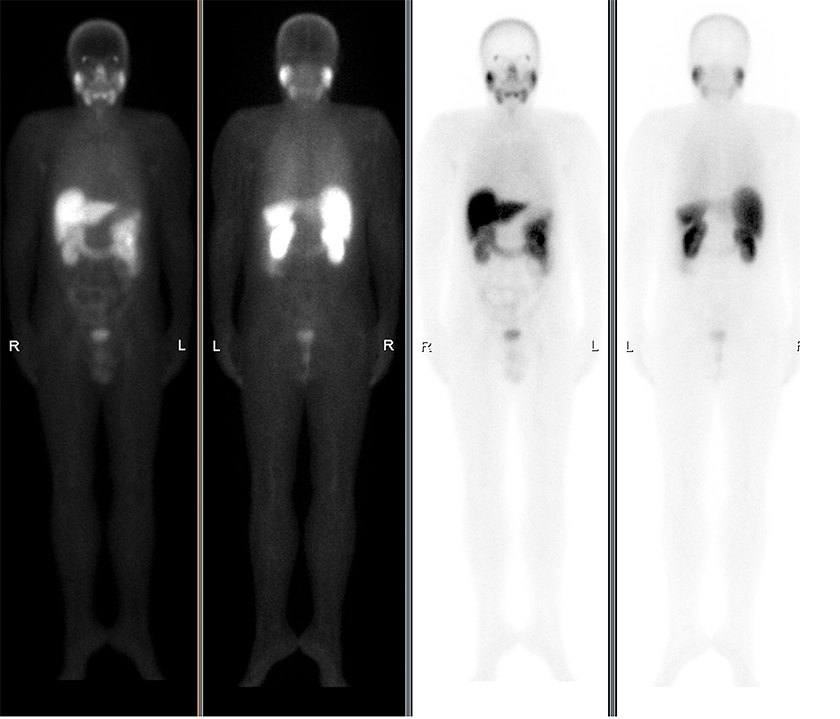 Gammagrama de cuerpo entero con PSMA