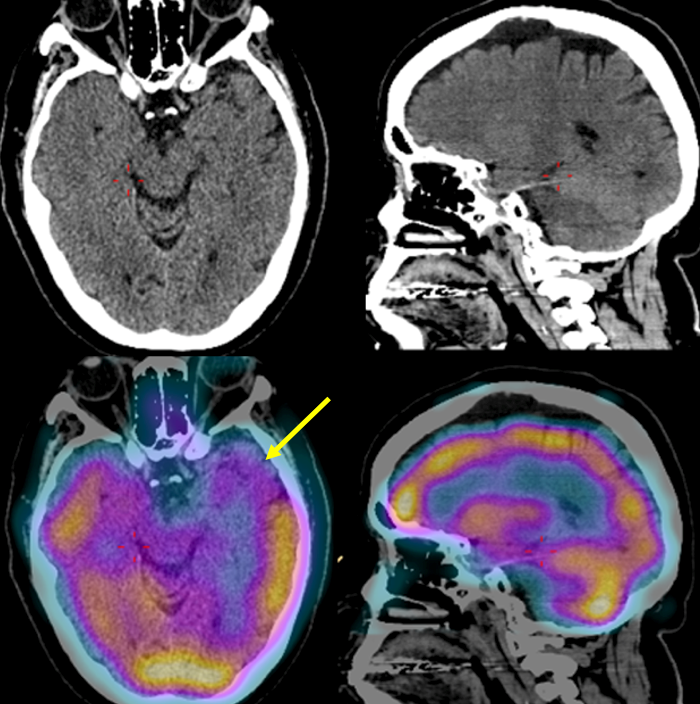 SPECT CT con 99mTc ECD