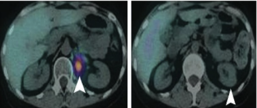 SPECT CT con 99mTc ECD
